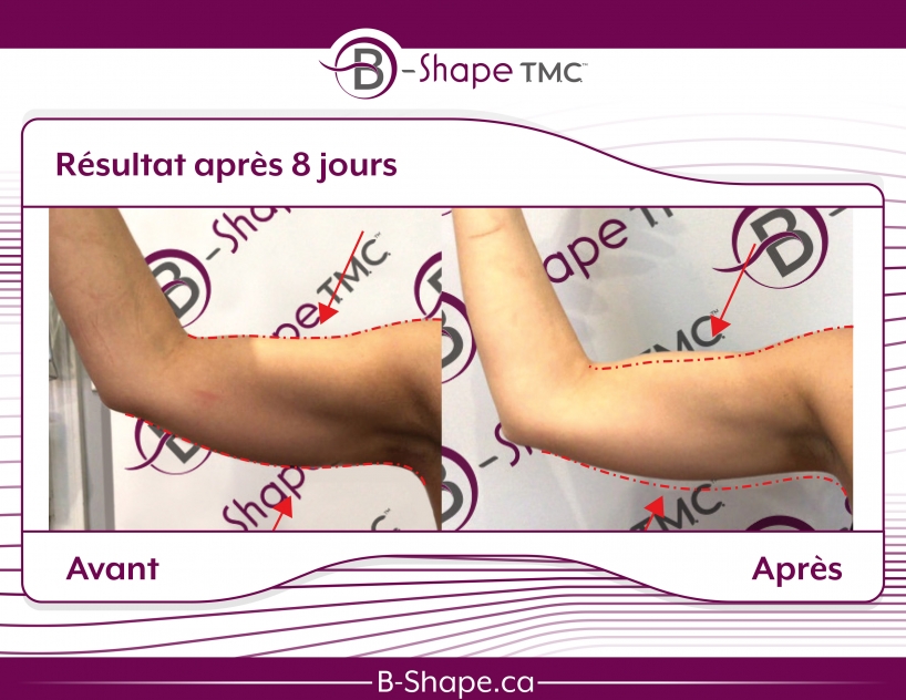 b-shape avant-après bras