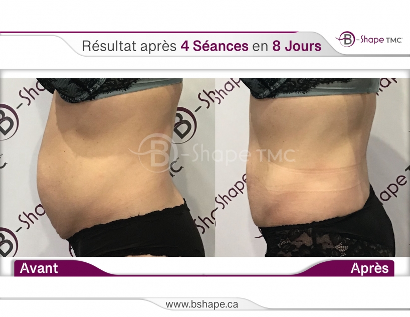 B-Shape (avant-après femme)