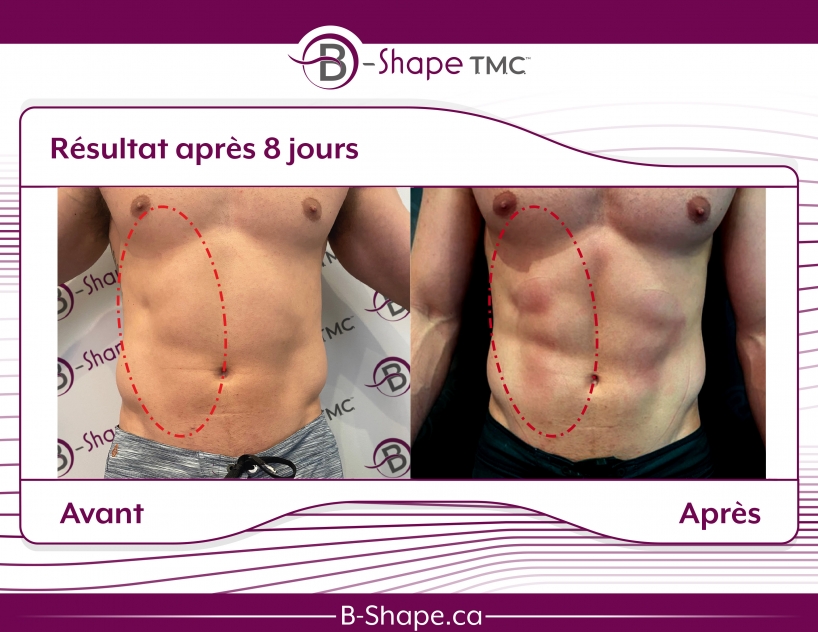 b-shape avant-après ventre homme