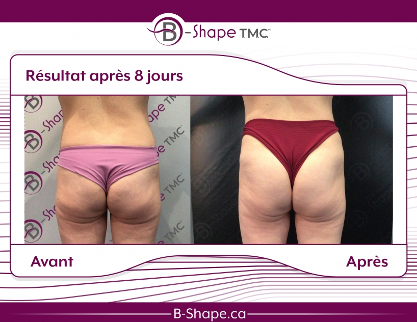 b-shape avant-après fesses