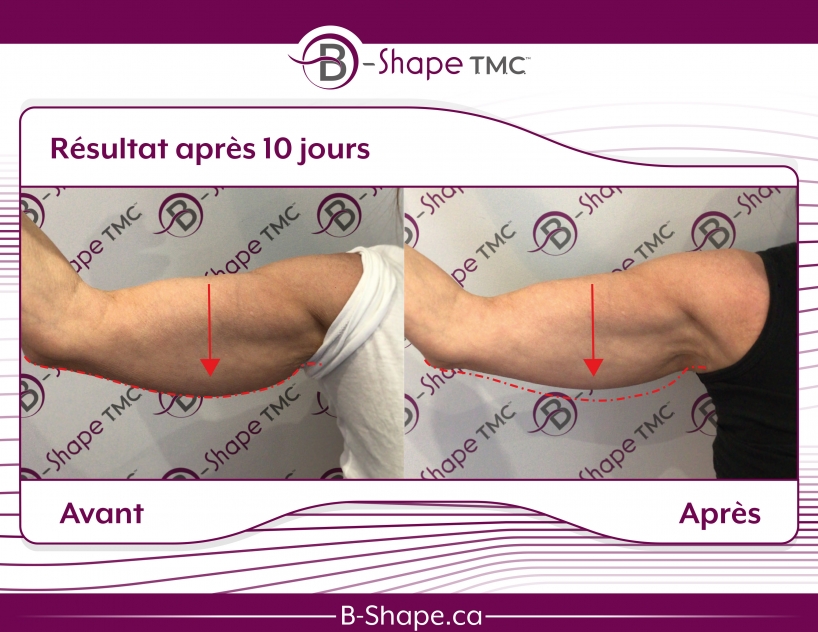 b-shape avant-après bras homme