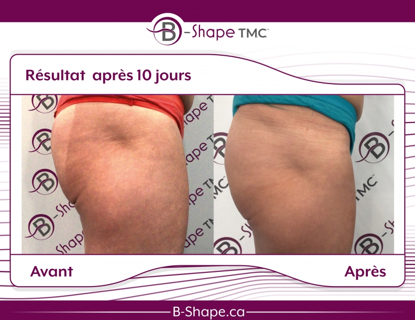 b-shape avant-après fesses