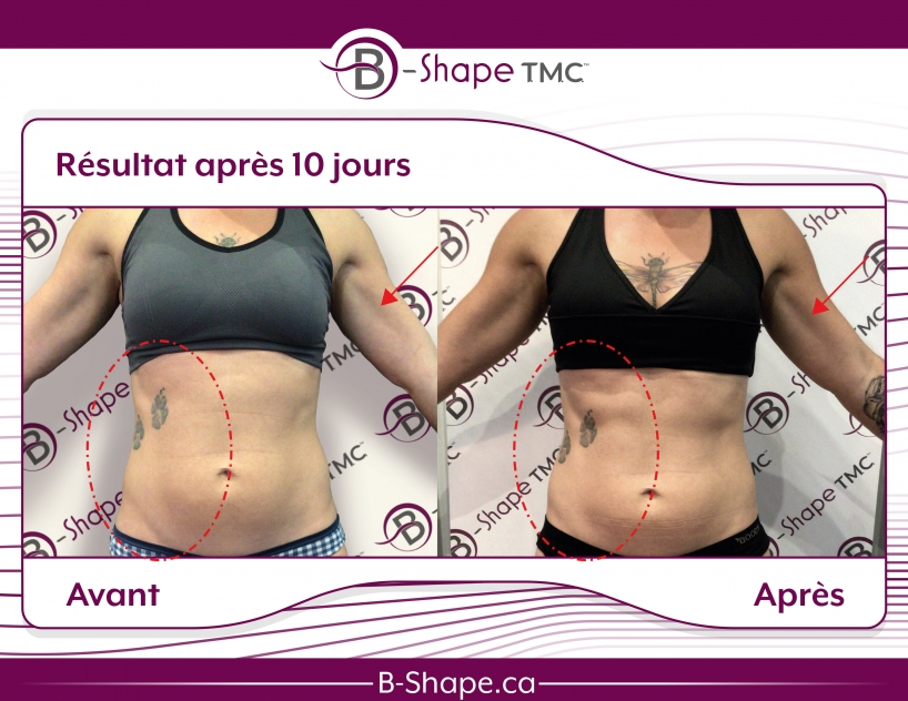 b-shape avant-après ventre femme