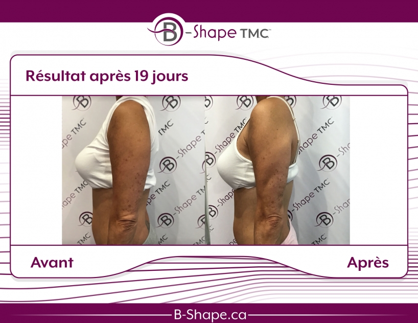 b-shape avant-après bras