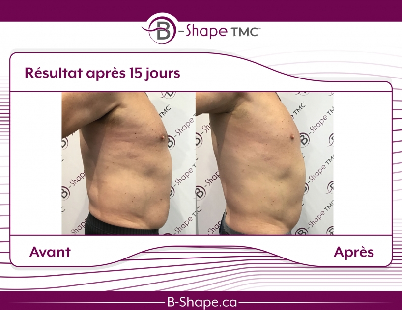 b-shape avant-après ventre profil homme