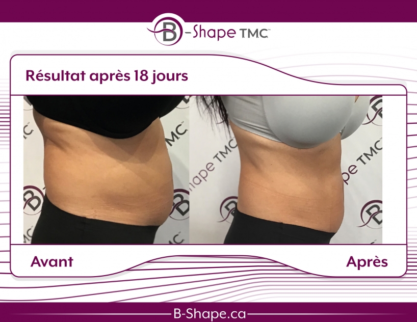 b-shape avant-après ventre profil femme